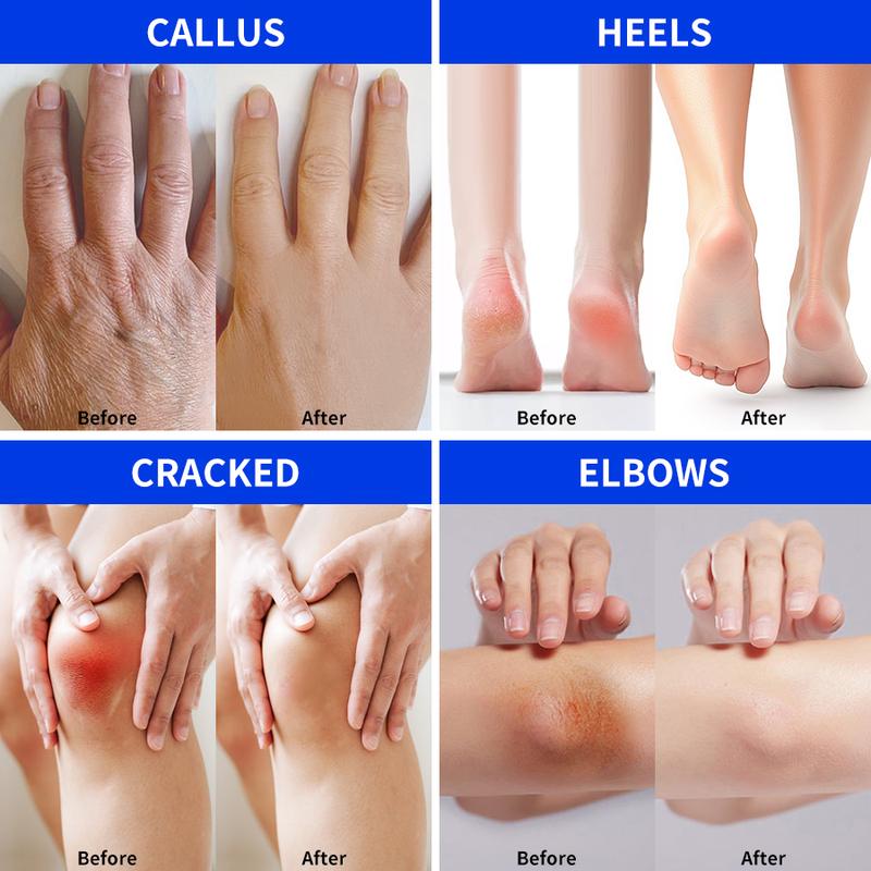 Aavini Intense Foot Cream - Repairs Cracked Skin, Antibacterial and Deodorizing, Removes and Softens Calluses, For All Skin Types, Moisturizing Foot Lotion