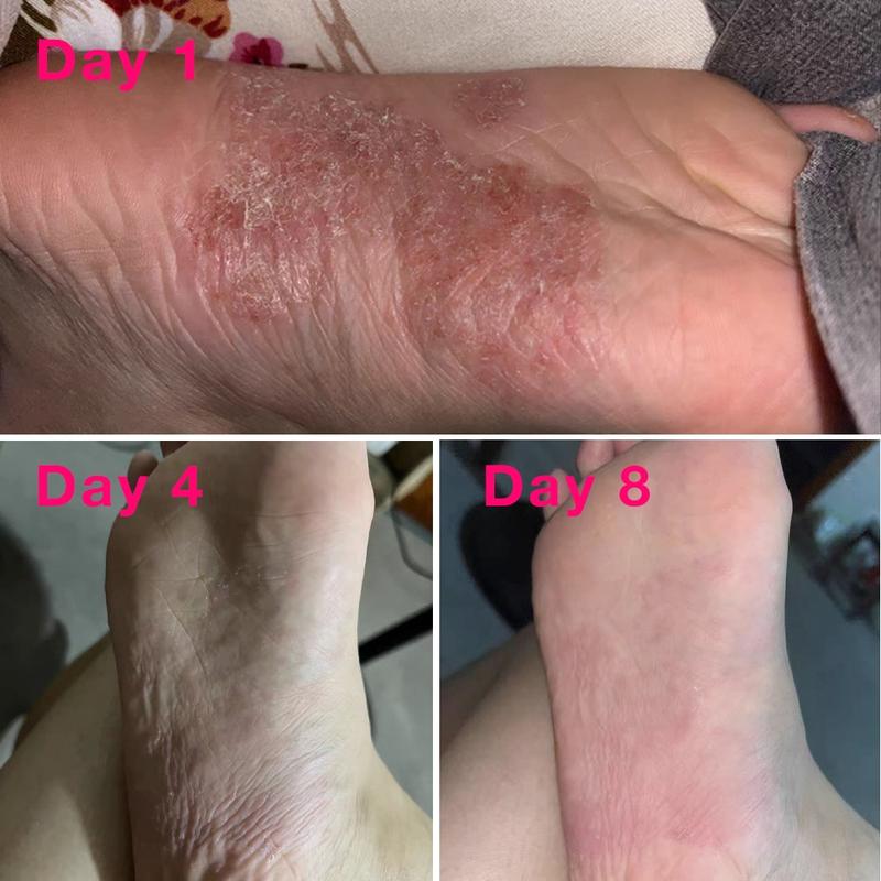Tea Tree Oil Foot Sanitizer Spray for Dry Cracked Feet, Nail Fungus, Jock Itch, Ringworm, Cracked Heels, and Itchy Skin | Foot Spray